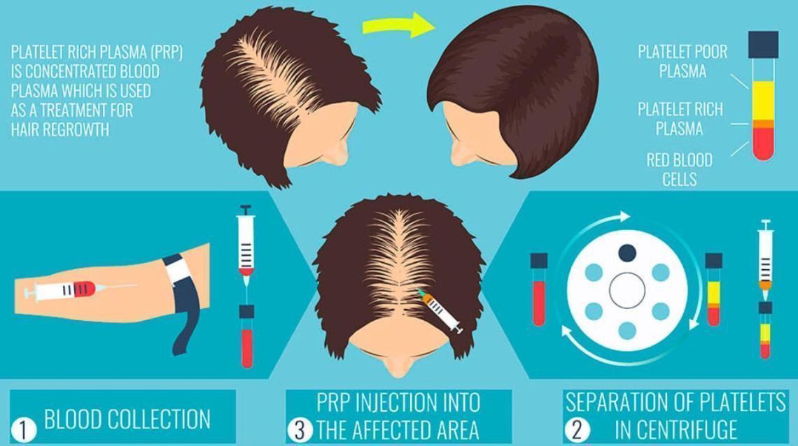 prp treatment for hair fall